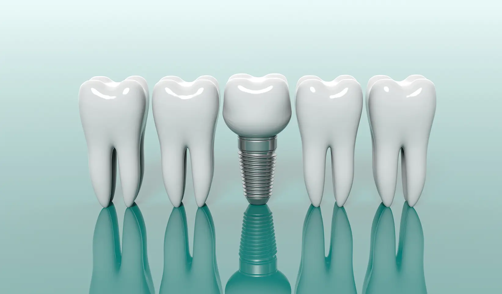 「初診相談無料」多様なインプラント埋入実績